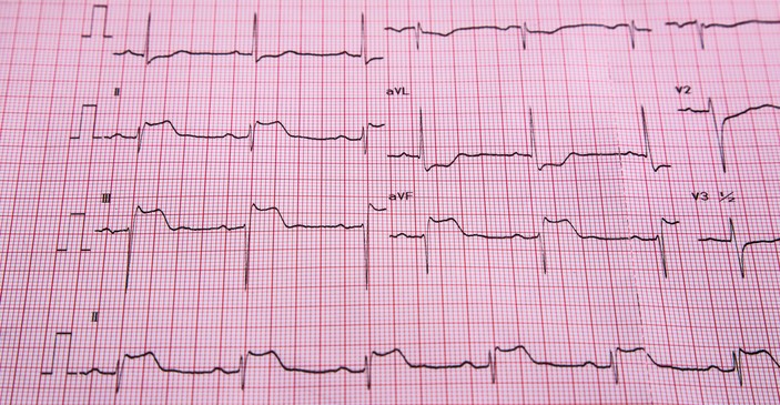 EKG - STEMI - tegn på ST-elevasjon og hjertemuskelinfarkt