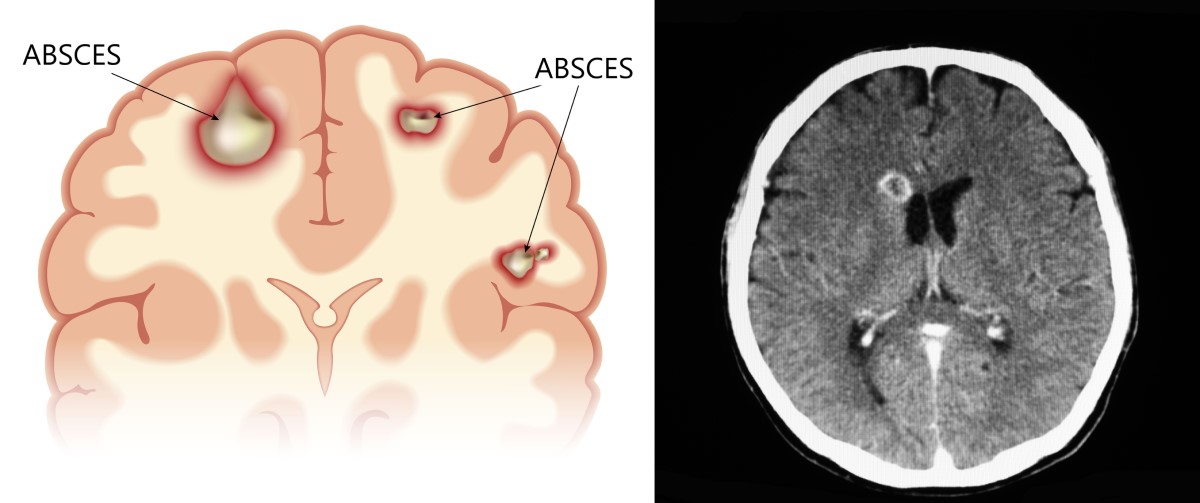 Anatomiske bilder og CT-skanning av en hjerneabscess