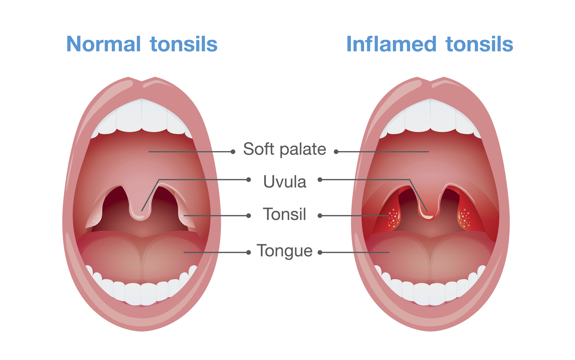 Angina - betennelse i mandlene