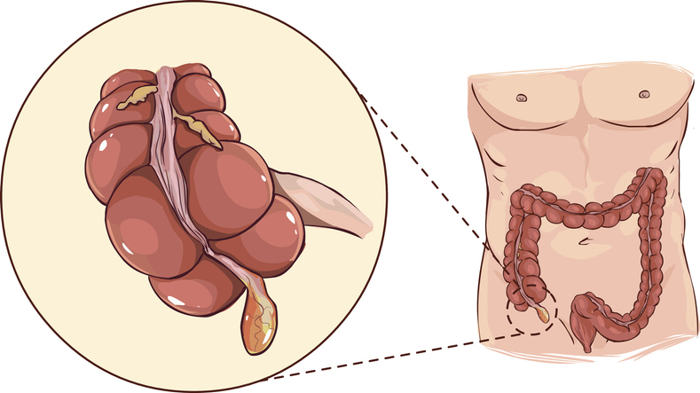 Appendix - anatomisk representasjon i begynnelsen av tykktarmen