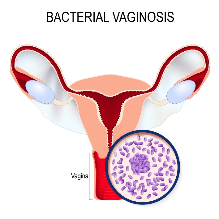 Bakteriell vaginose og Gardnerella vaginalis-overvekst