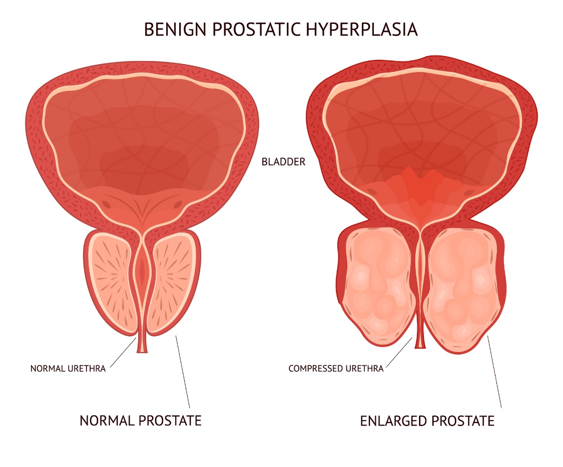 Godartet (benign) prostatahyperplasi