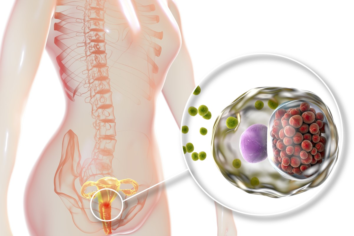 Infeksjon har invadert livmorhalsen - anatomisk fremstilling av det kvinnelige reproduksjonssystemet