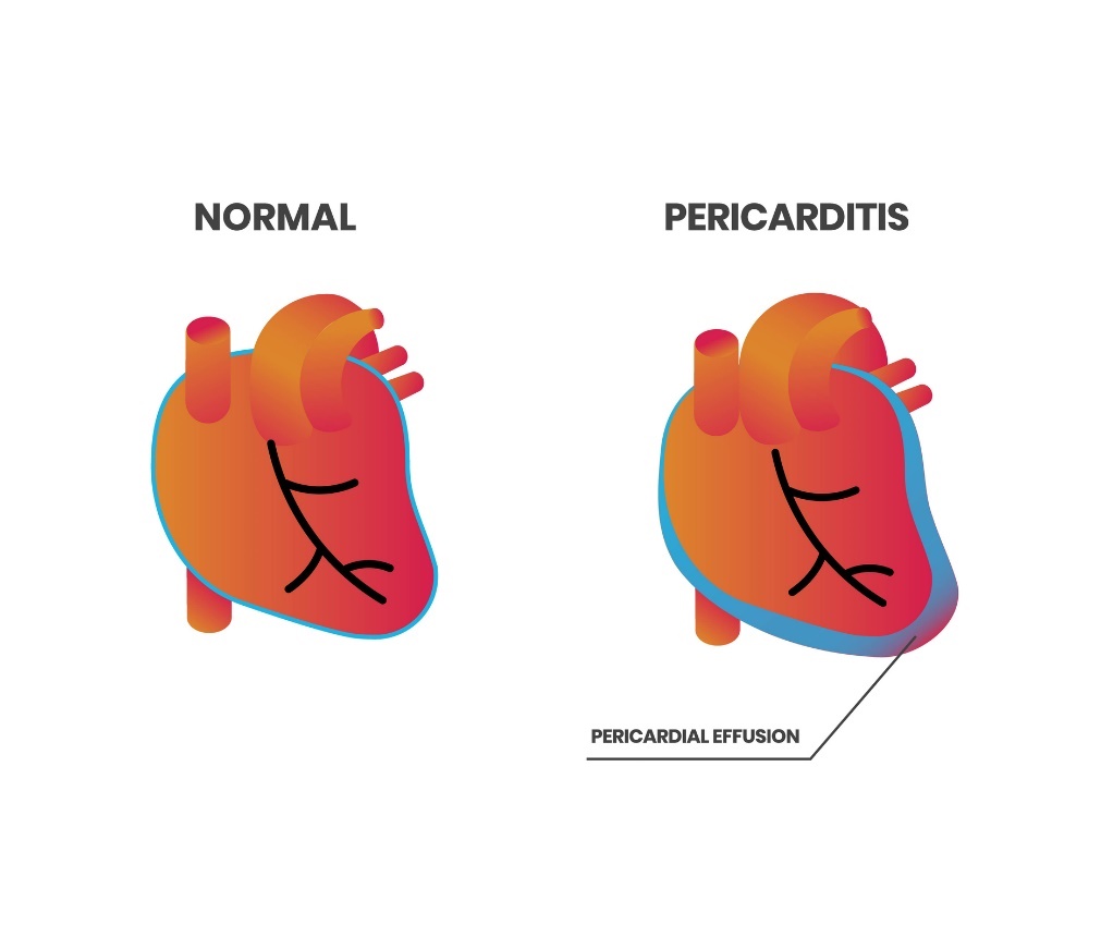 Hjertefysiologi og perikarditt (perikardieeffusjon)