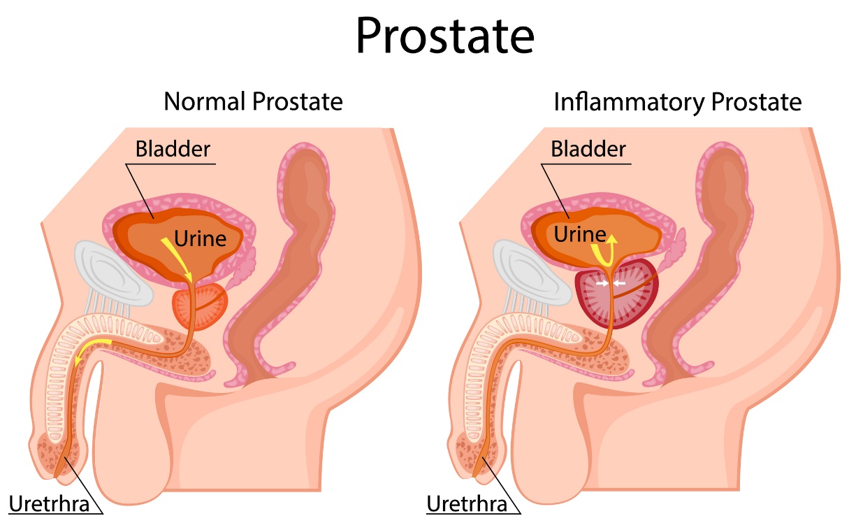 Venstre: fysiologisk prostata, høyre: forstørret prostata. Ligger under blæren. Blære, urin, urinrør.