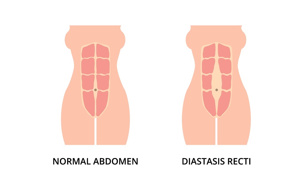 Fysiologisk tilstand i magemusklene og diastase (avstand mellom venstre og høyre rectus abdominis-muskel fra linea albas midtlinje