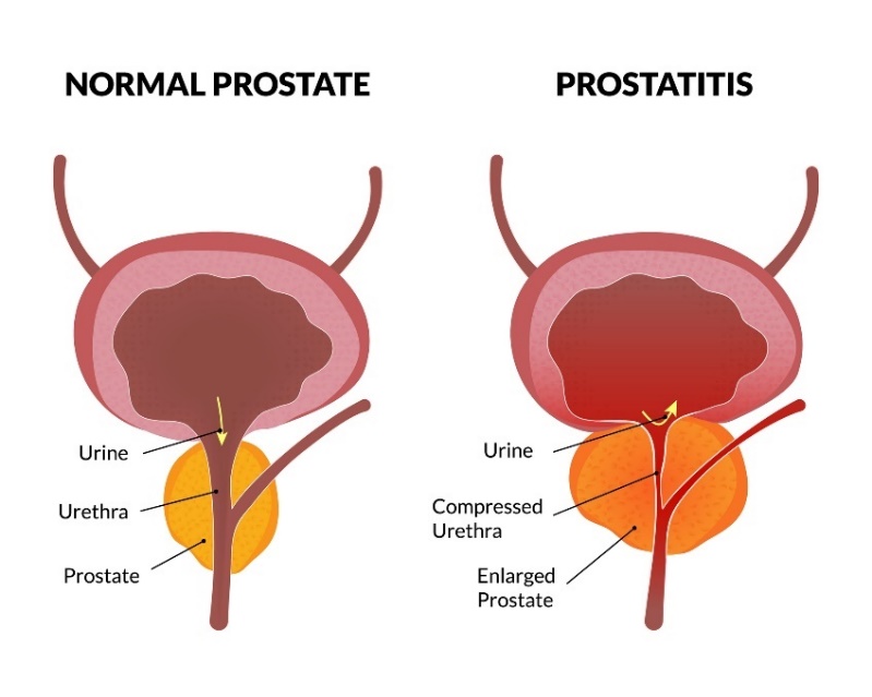 Den fysiologiske tilstanden til prostata og prostatitt