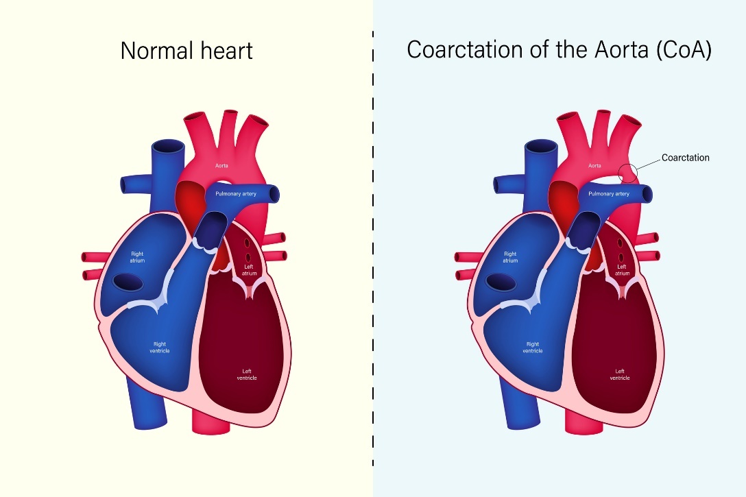 Hjertets fysiologiske tilstand og koarktasjon av aorta (CoA)