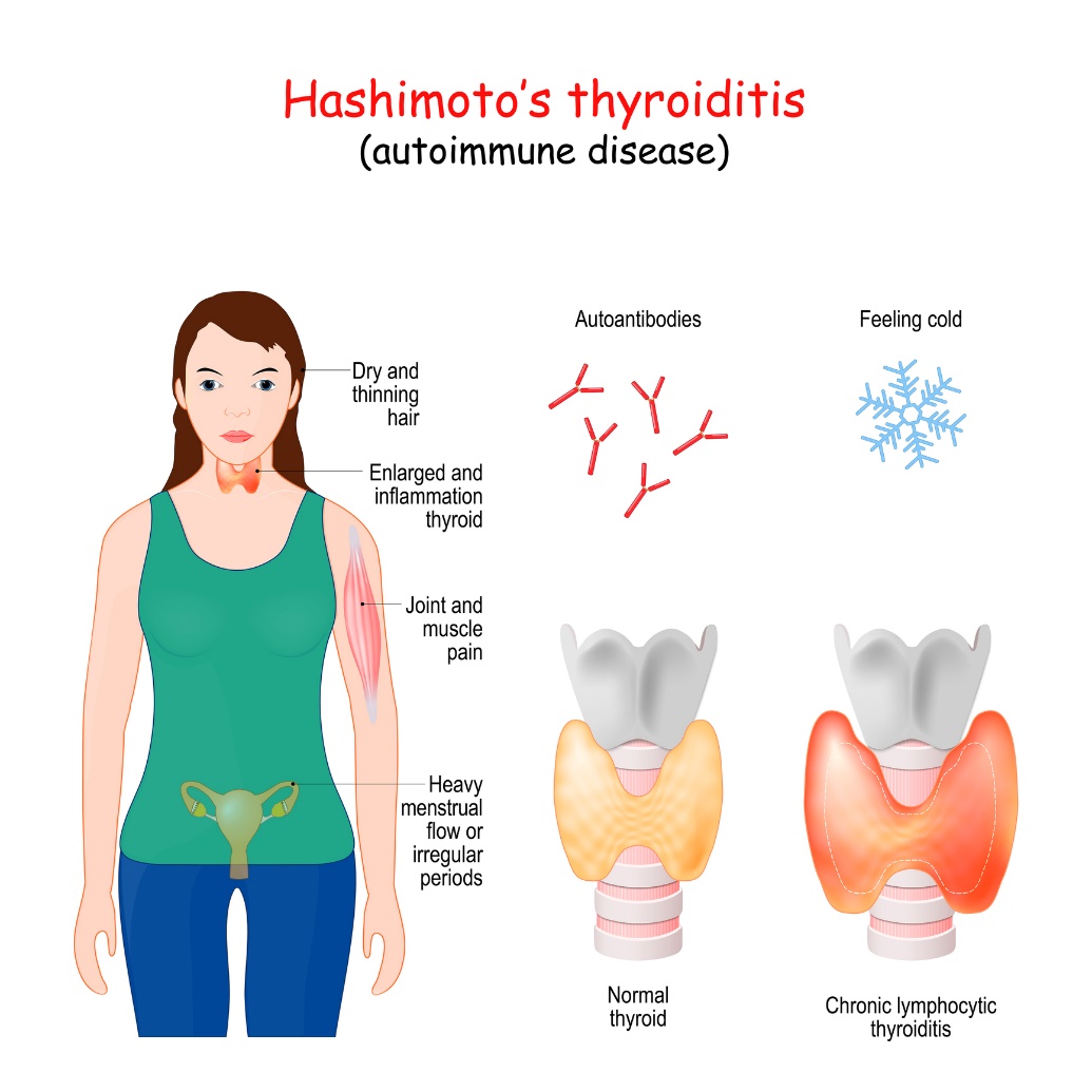 Hashimotos tyreoiditt og kliniske symptomer