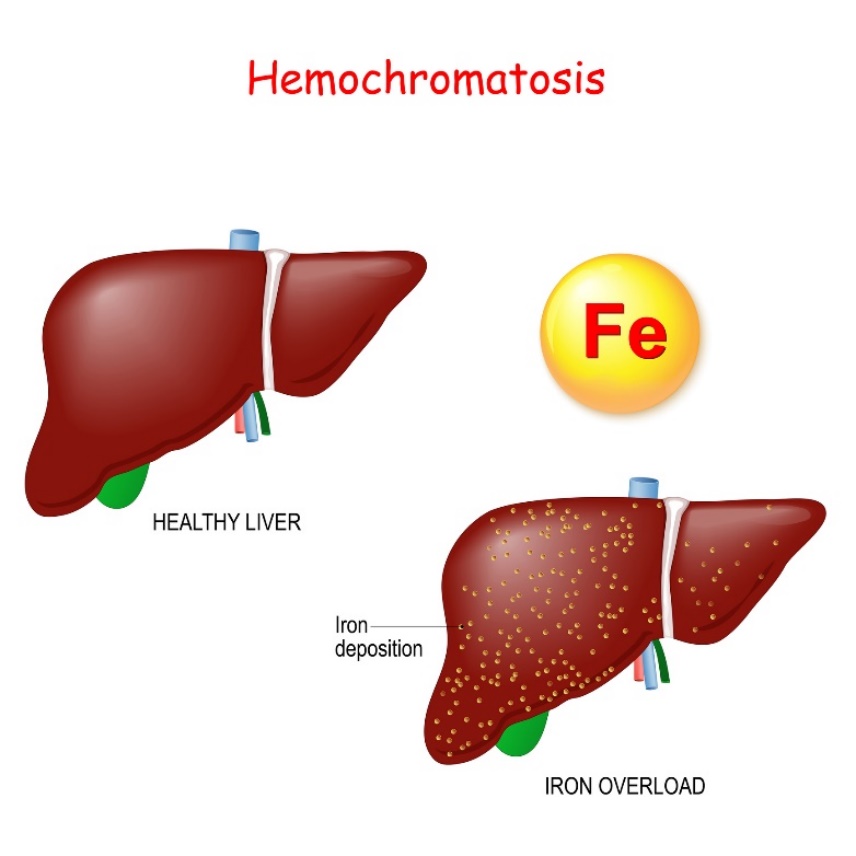 Hemokromatose: fysiologi og patologi i leveren med overdreven avleiring av jern (Fe)