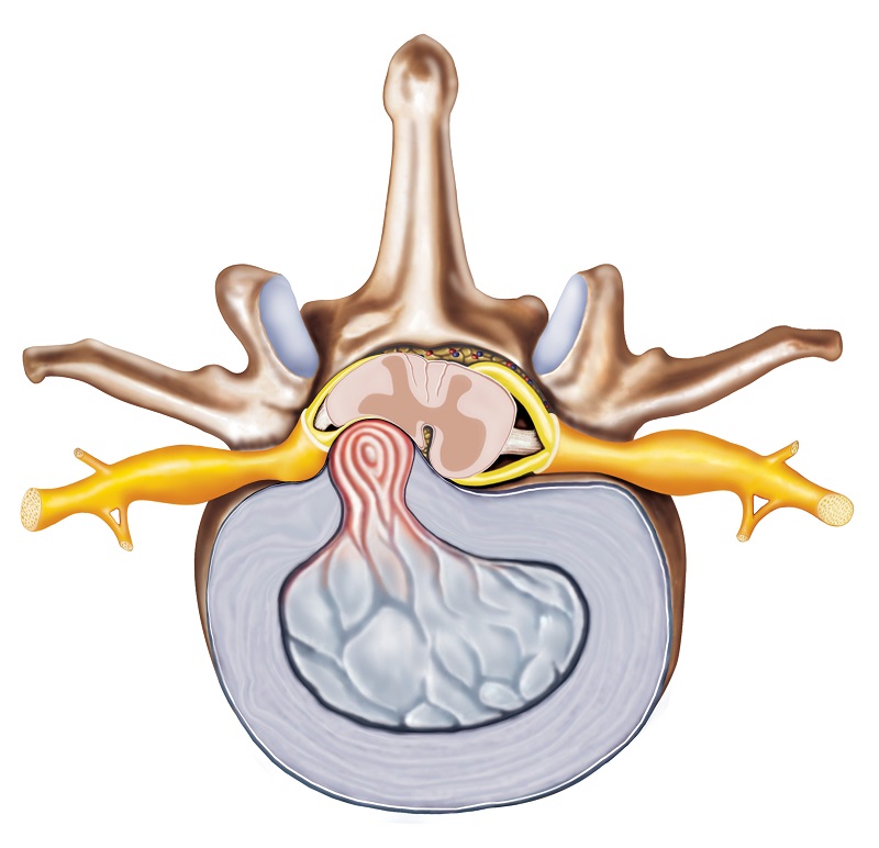 Diskusprolaps - anatomisk fremstilling