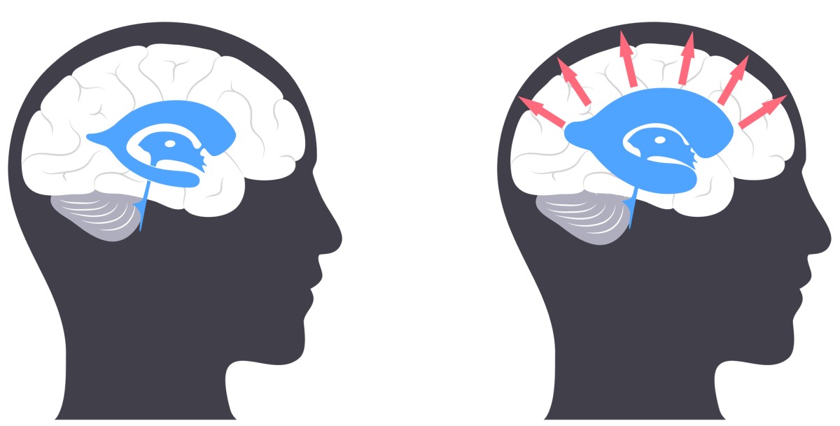 Hode med hjerne - til venstre - normal hjerne / til høyre - hode med hjerne med hydrocephalus, der pilene fra midten og utover indikerer forstørrelse av hjerneventriklene og trykk på hjernevevet.