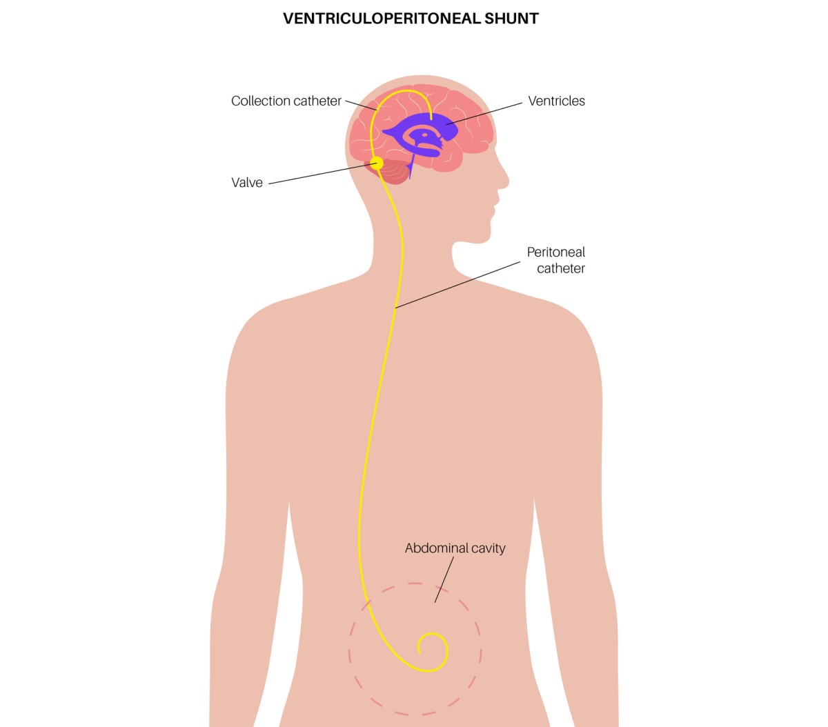 Illustrasjon av en ventrikulo-abdominal shunt som drenerer overflødig væske fra hjernen til bukhulen.