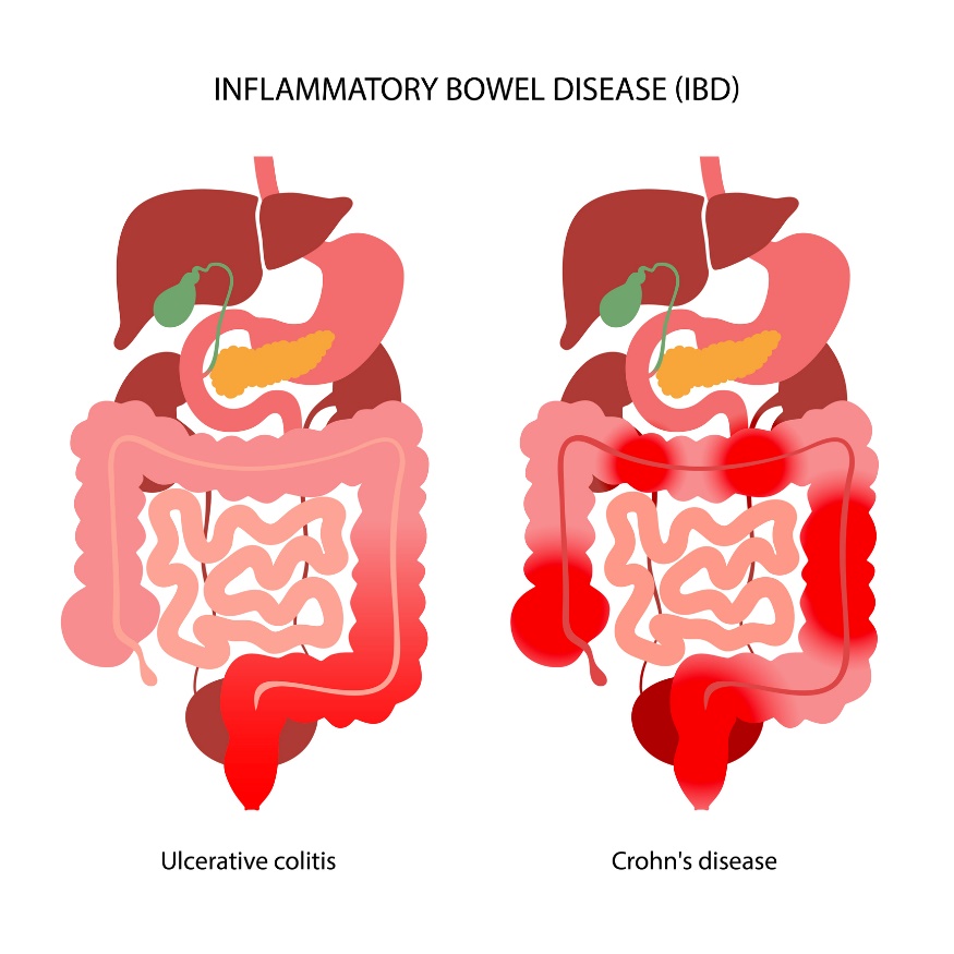 IBD: Inndeling i ulcerøs kolitt og Crohns sykdom i henhold til lokaliseringen av betennelsesreaksjonen.