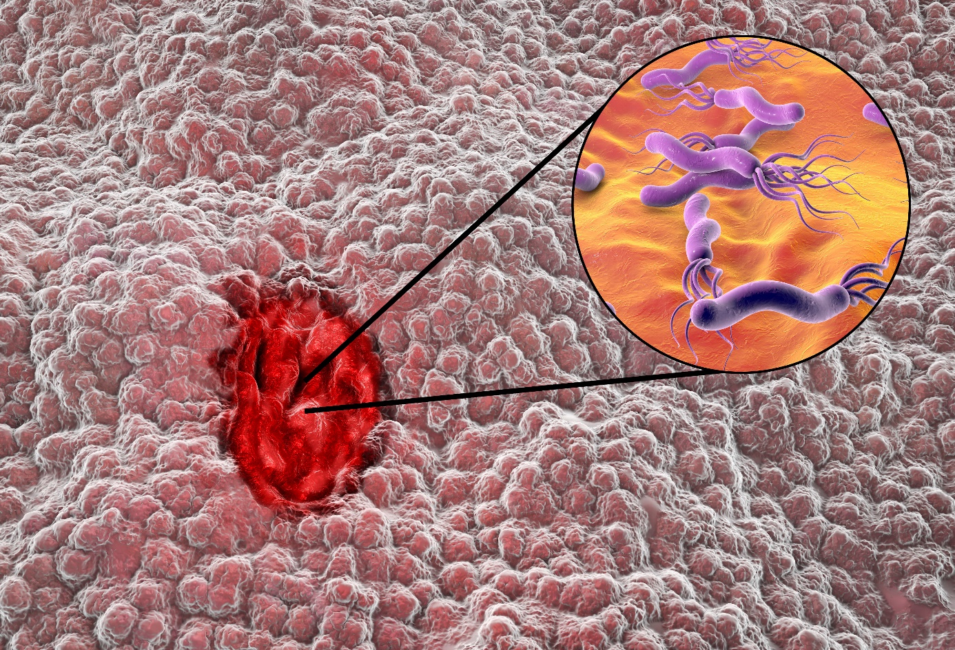 Helicobacter pylori-infeksjon