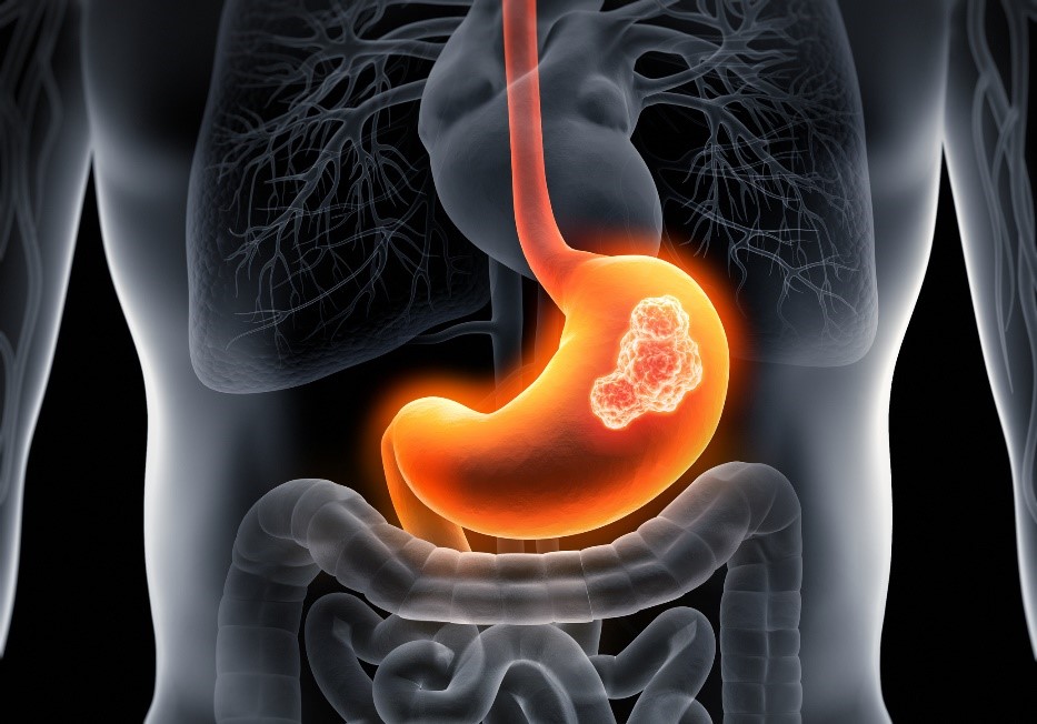 Anatomisk modell for gastrisk karsinom (magekreft).