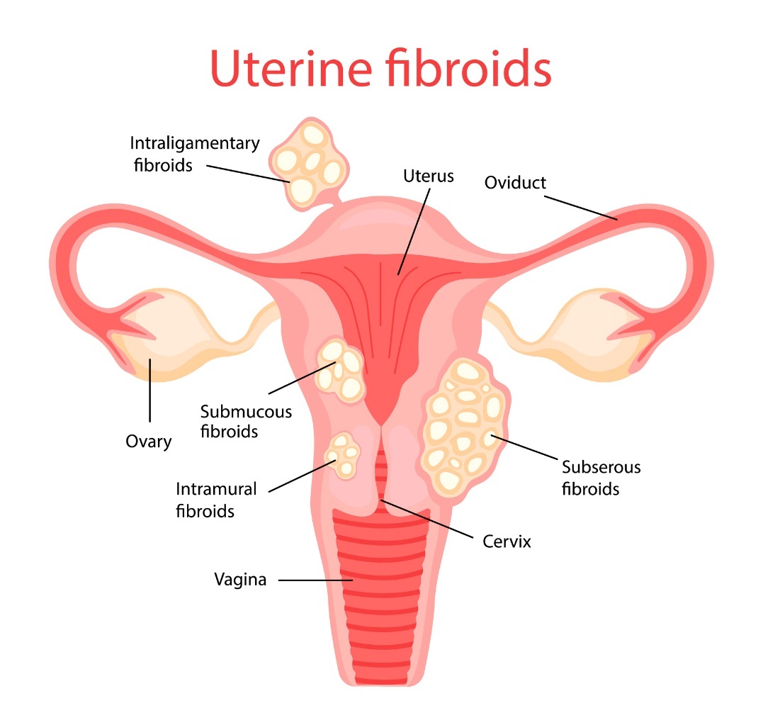 Fibroider i livmoren (uterine fibroider)