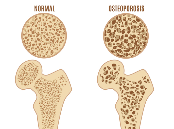 Osteoporose i lårbenet