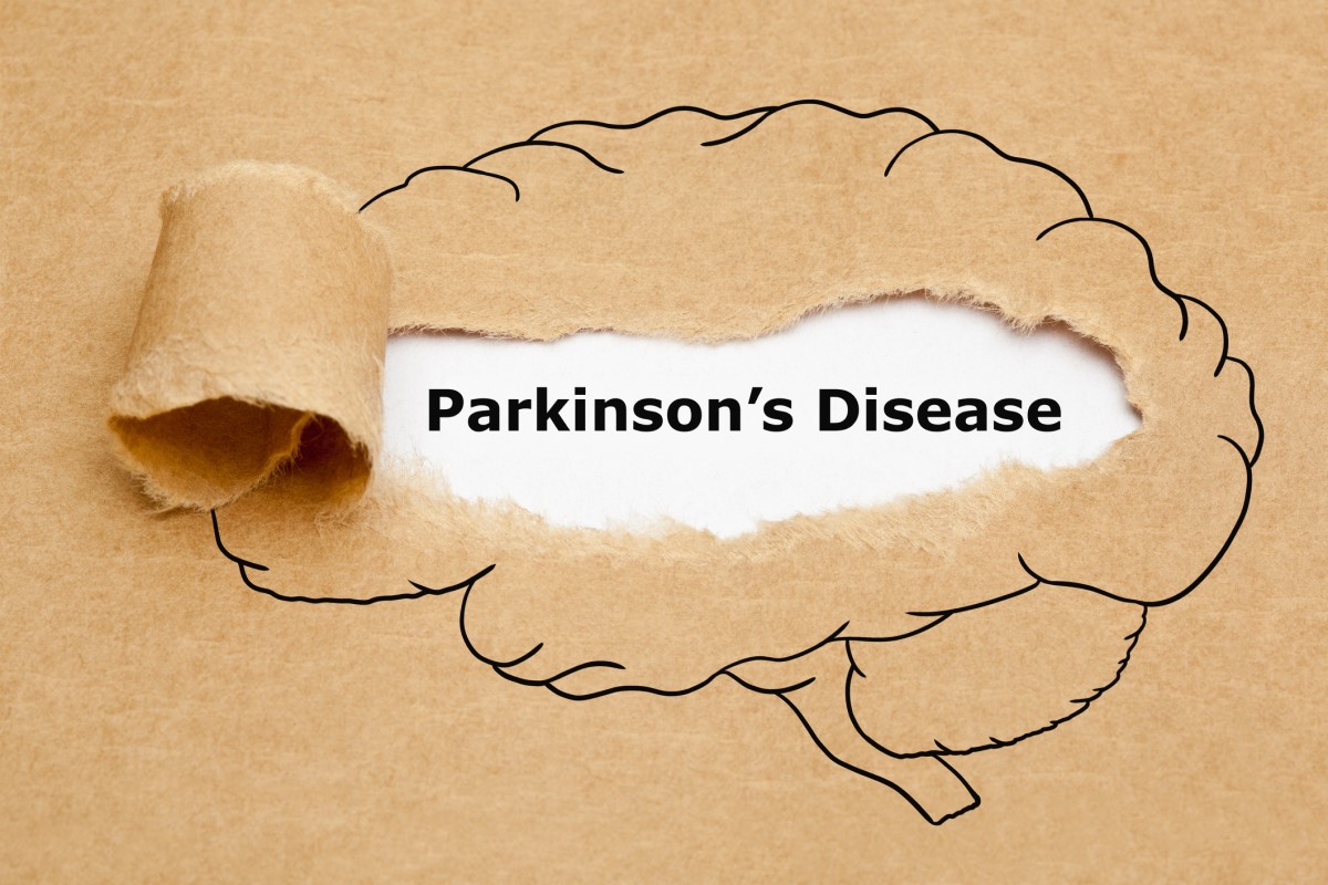 Morbus Parkinson = Parkinsons sykdom = Parkinsons sykdom - animasjon av en hjerne med Parkinsons sykdom i midten