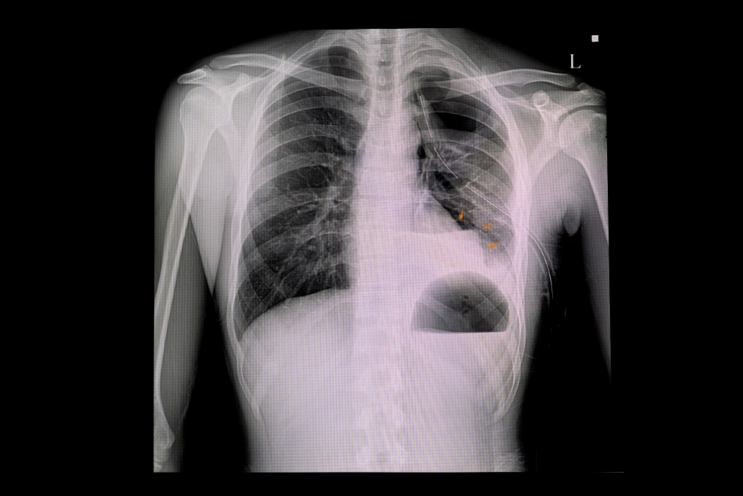 Røntgenbilde av pneumothorax i venstre lunge og luftansamling i brystkassens pleurahule (hvit farge)