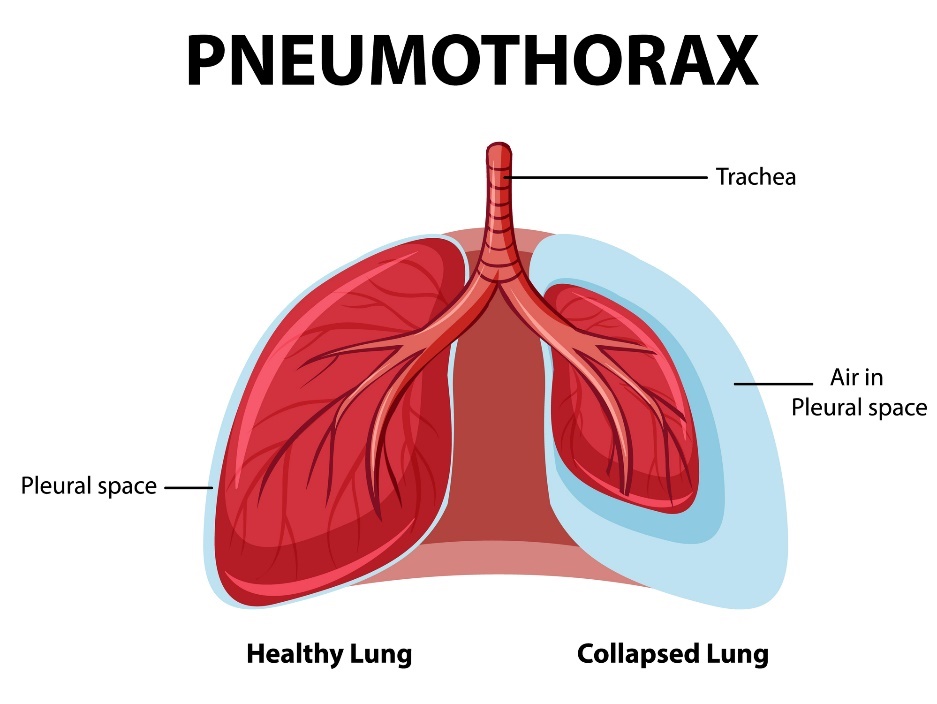 Pneumothorax: friske og kollapsende lunger