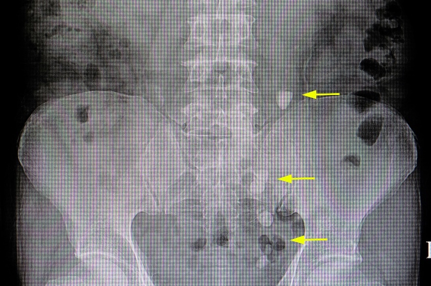 Røntgen: mange konkrementer i løpet av urinveiene