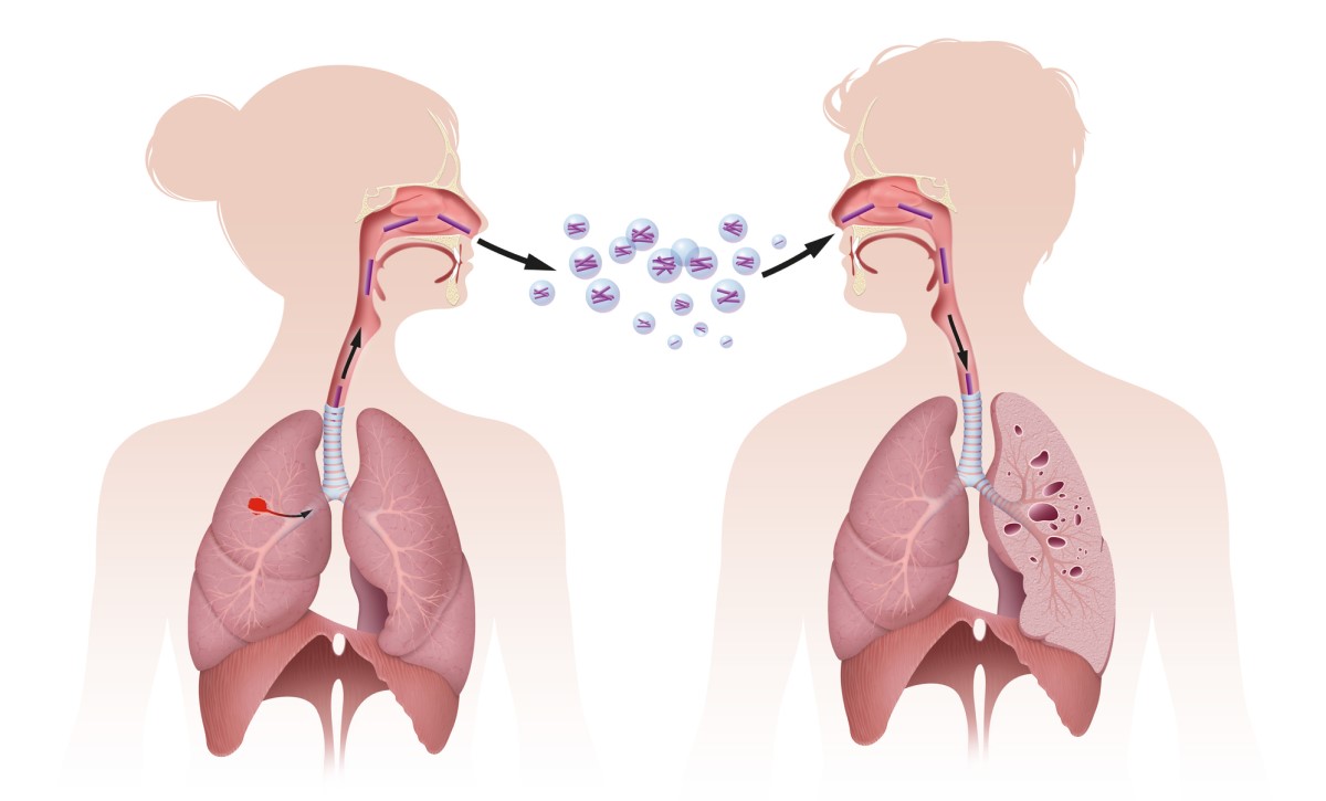 Overføring av TB ved inhalasjon, dvs. ved innånding, viser figuren overføring ved inhalasjon.