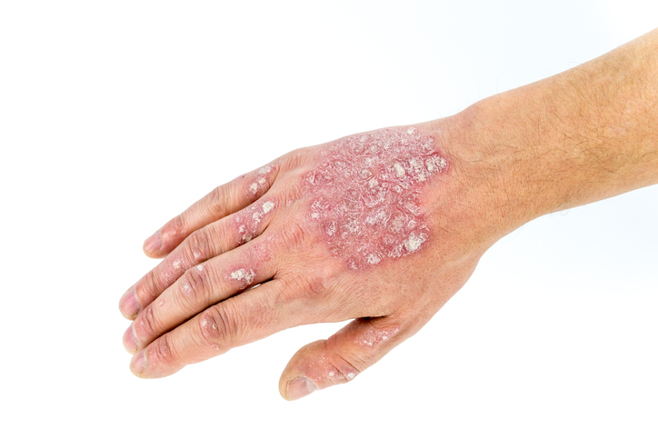 Psoriasis eller psoriasis på hånden, på håndryggen