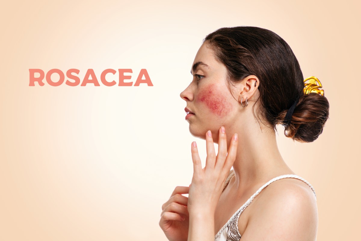 Kvinne fra siden, ansikt med rosacea - rosacea