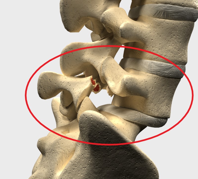 Spondylolisthesis i lumbalregionen L5 og S1 - modell av ryggskjelett