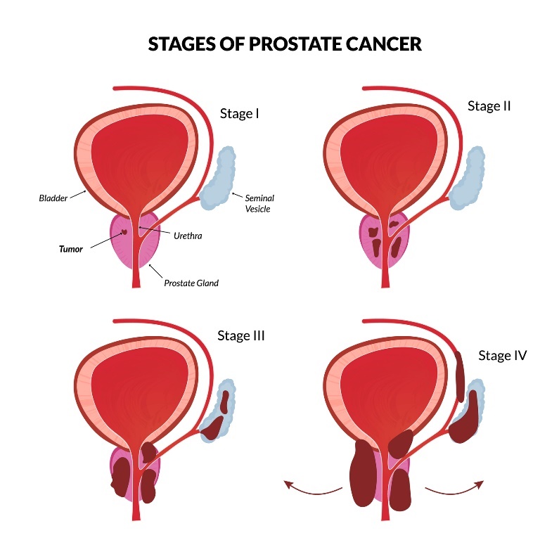 4 grunnleggende stadier av prostatakreft