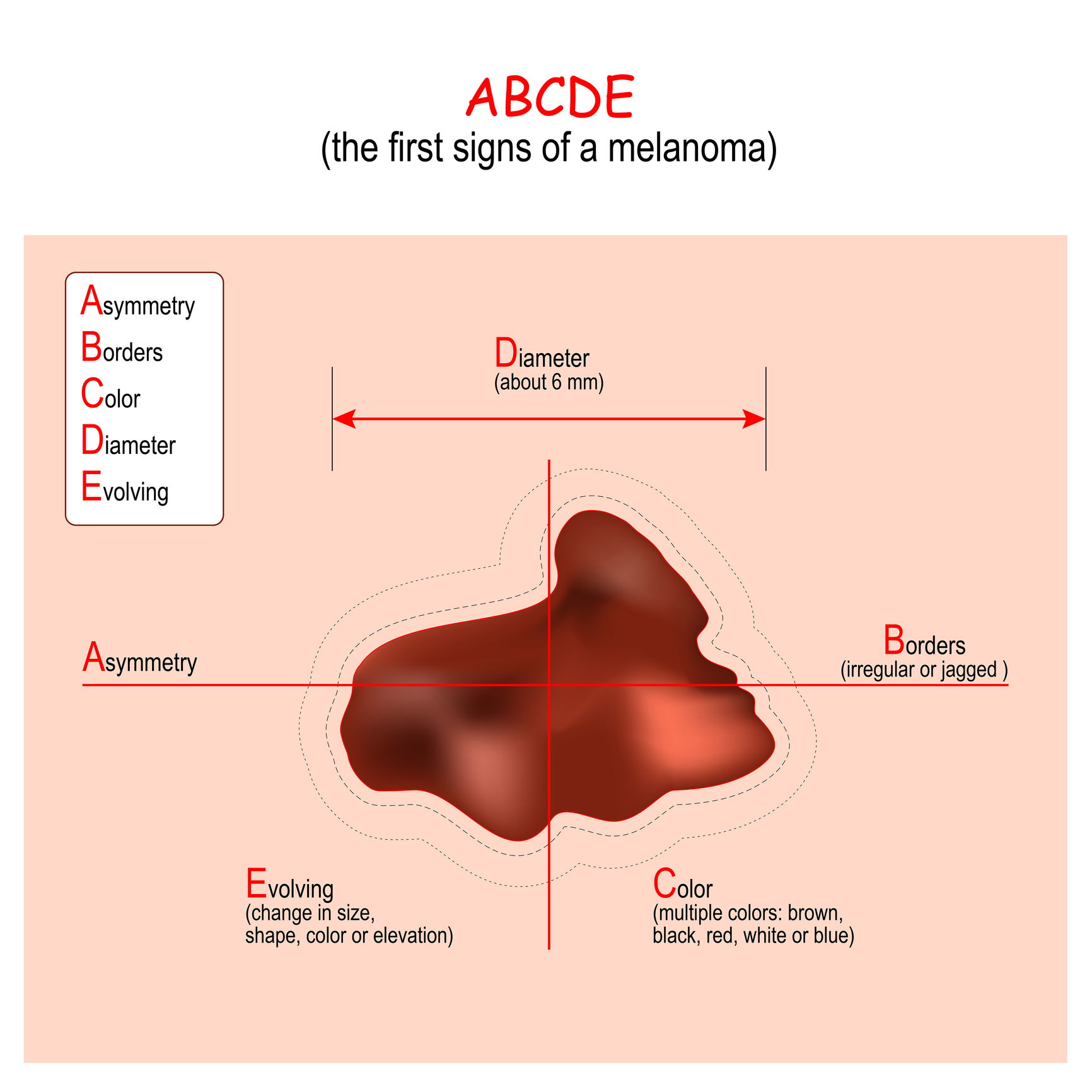 ABCDE-algoritmen