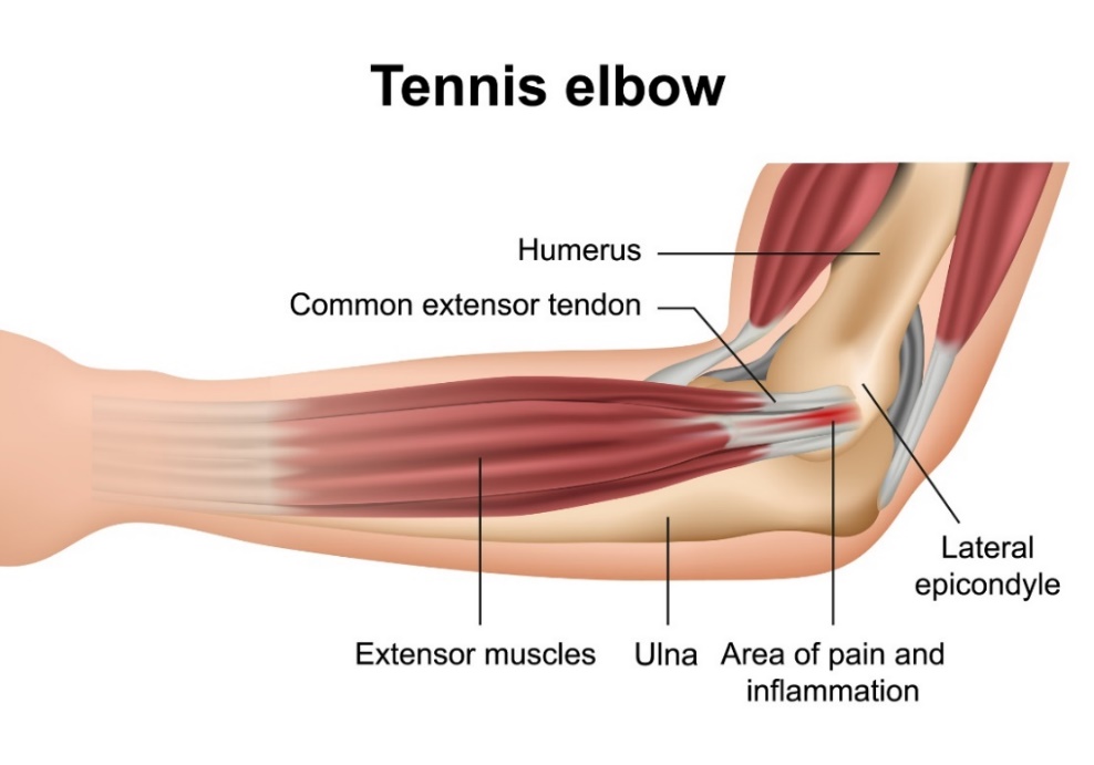 Tennisalbue (lateral epikondylit): beinene i albueleddet, strekkmusklene i underarmen, den laterale epikondylen og stedet for primære smerter.