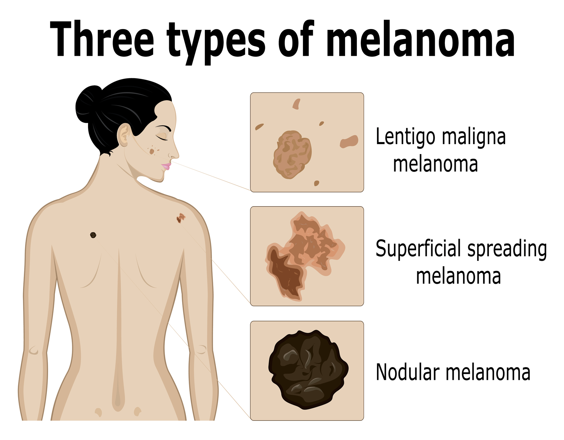 Bildediagnostikk av de tre typene melanom