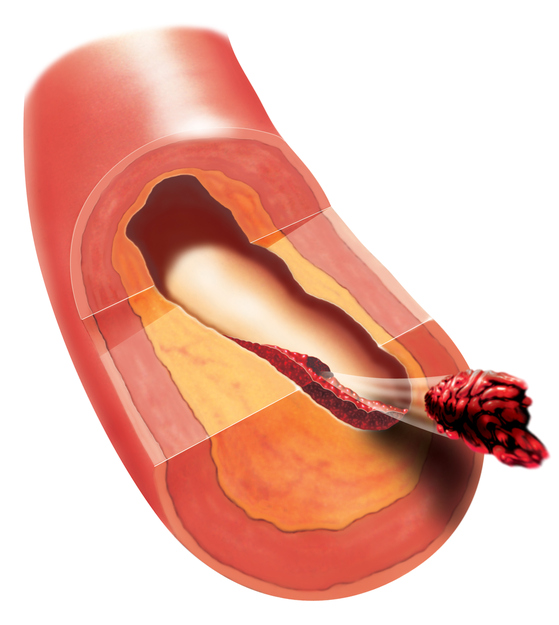 Trombose i et blodkar, tromboseløsning, embolus, emboli av en blodpropp