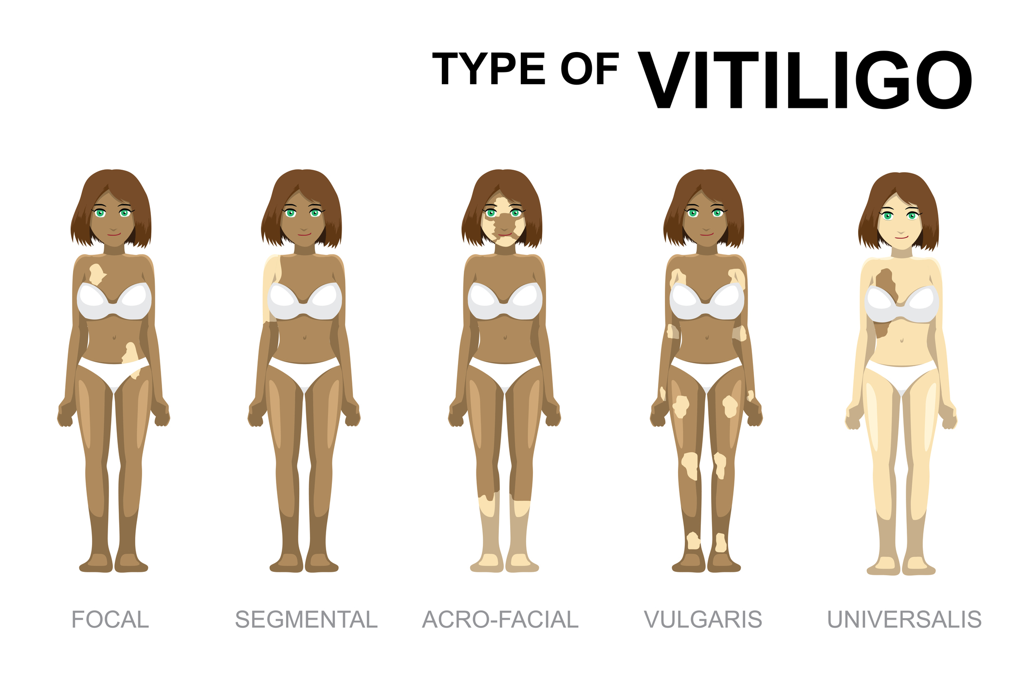 Typer av vitiligo