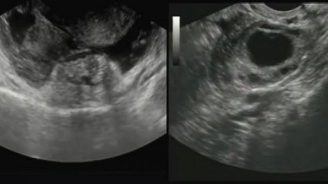 USG - sonografi av magen - bilde under undersøkelse, avbildning av livmor og graviditet utenfor livmoren