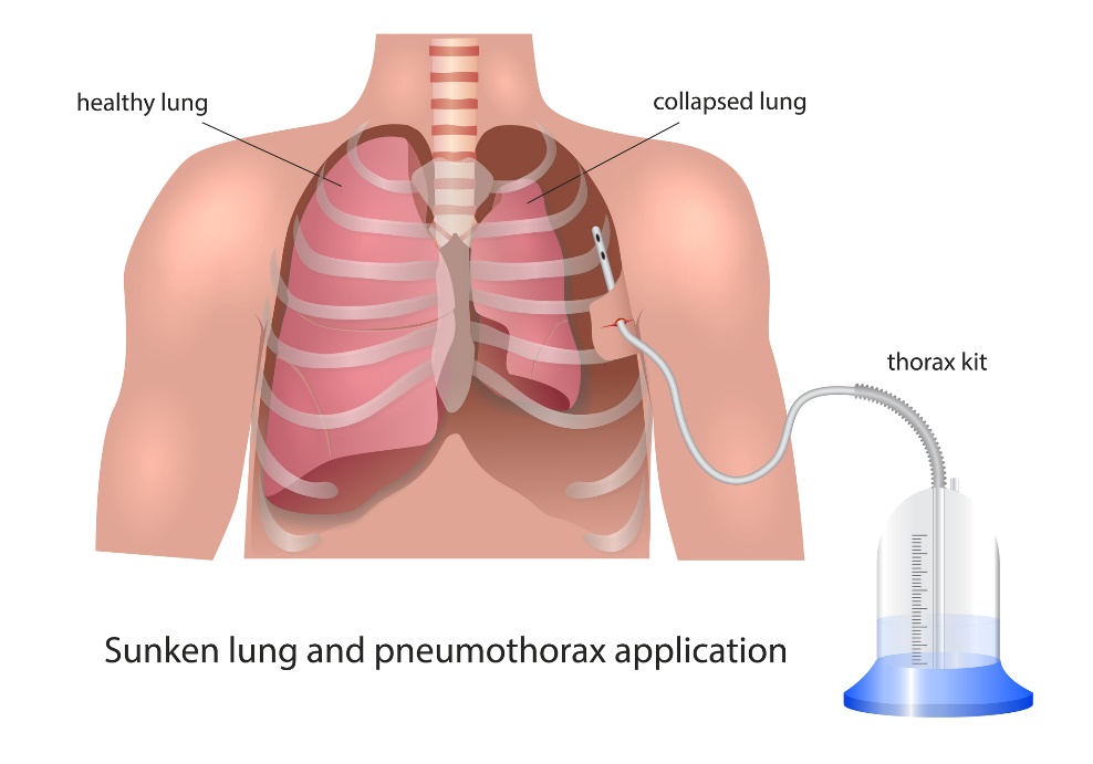 Visualisering av pleuradrenasje ved pneumothorax: frisk lunge, kollapset lunge og drenasjeanordning