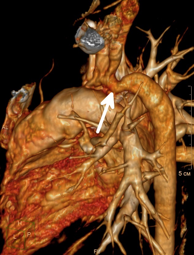 Visualisering av koarktasjon (innsnevring) av aorta i den nedadgående delen av hjertekarsystemet.