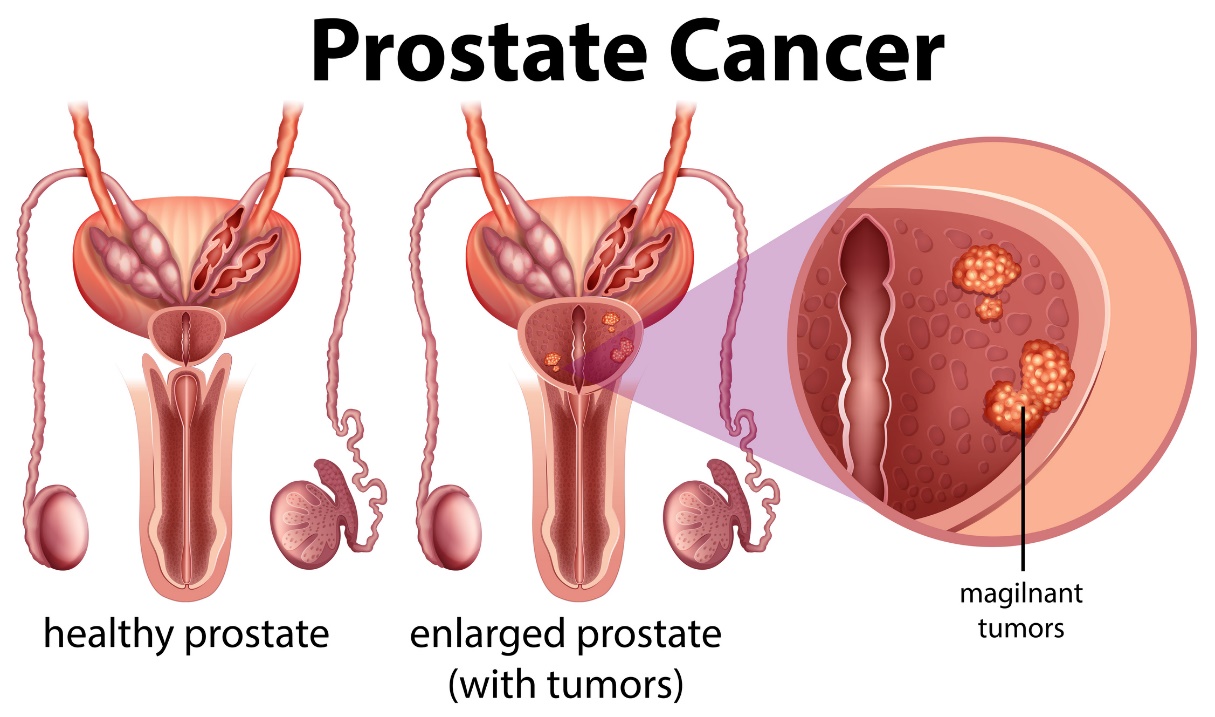 Prostatakreft, frisk prostata og forstørret prostata med svulst