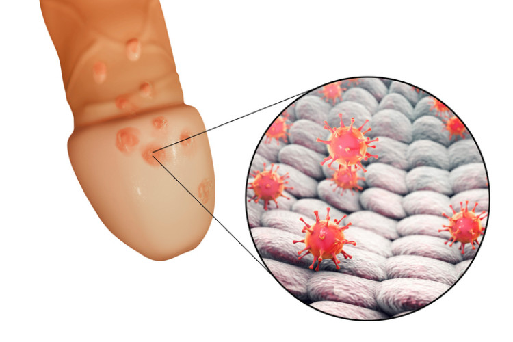 Genital herpes på penis og herpesvirus på mikroskopisk nivå