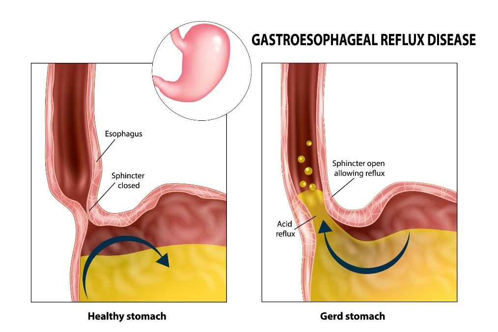 Gastroøsofageal refluks: spiserør, lukkemuskel, magesekk og magesyre