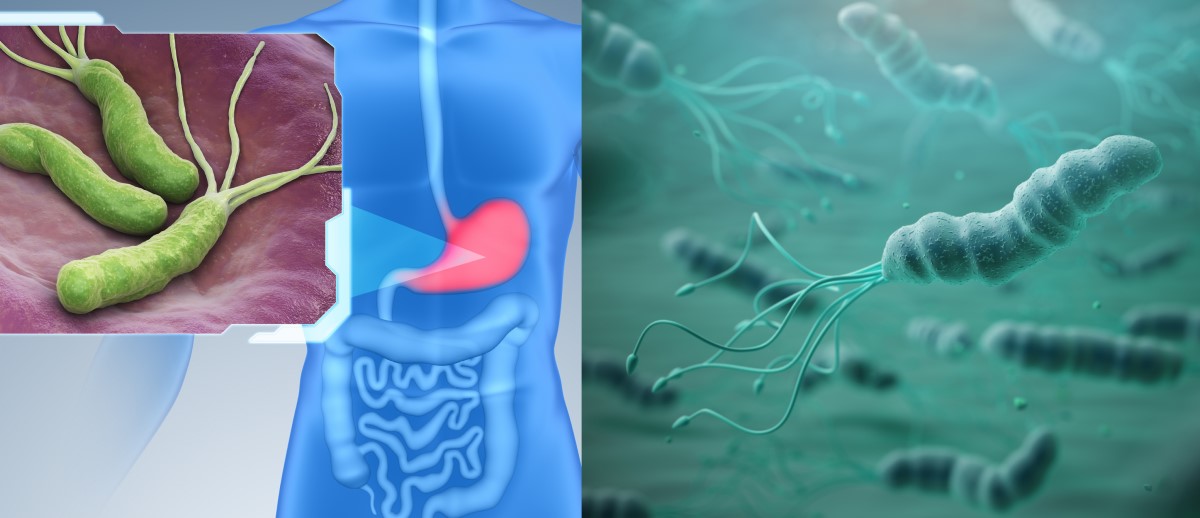 Helicobacter pylori koloniserer mageslimhinnen og er en risikofaktor for gastritt, magesår og kreft.