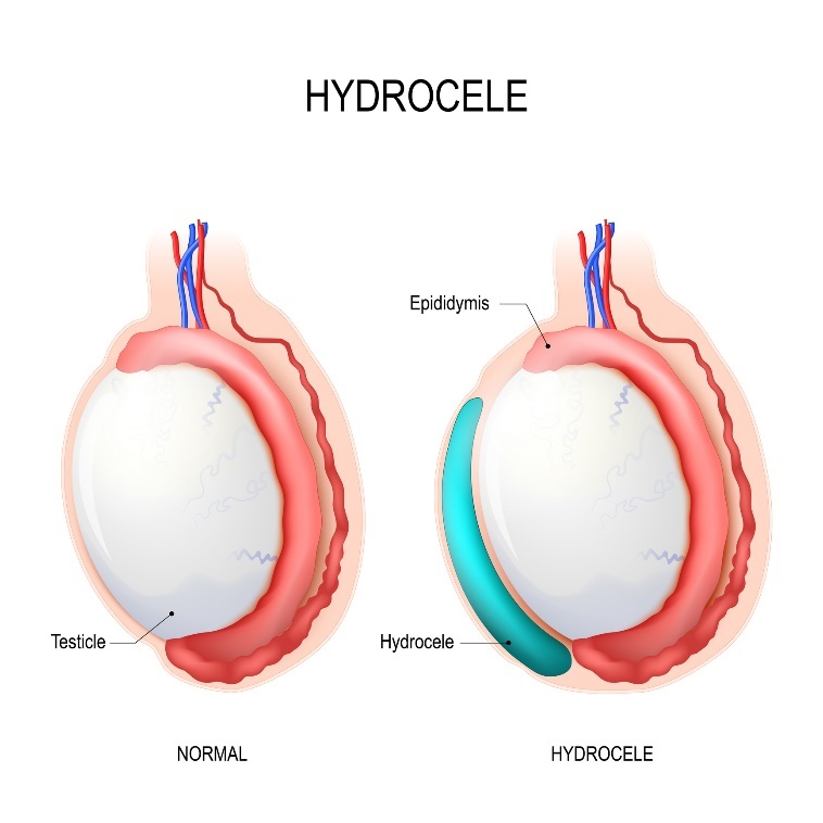 Hydrocele: testikkel, Epididymis (bitestikkel), Hydrocele (væskeansamling)