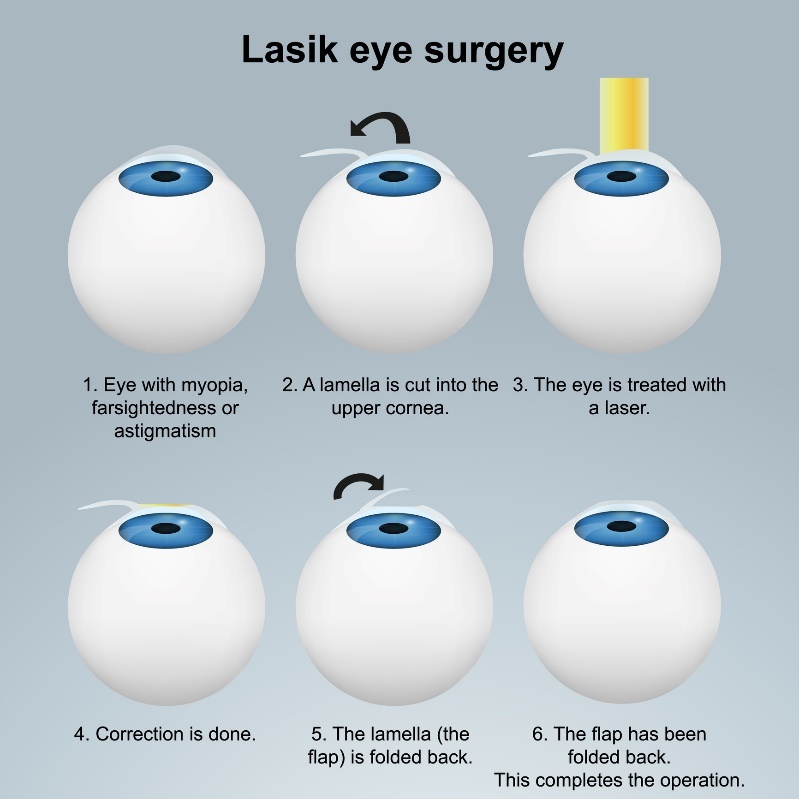 Øyelaseroperasjon LASIK - Subsurface-metoden: Prosedyre med klaff/flap uten å skade nerveendene.