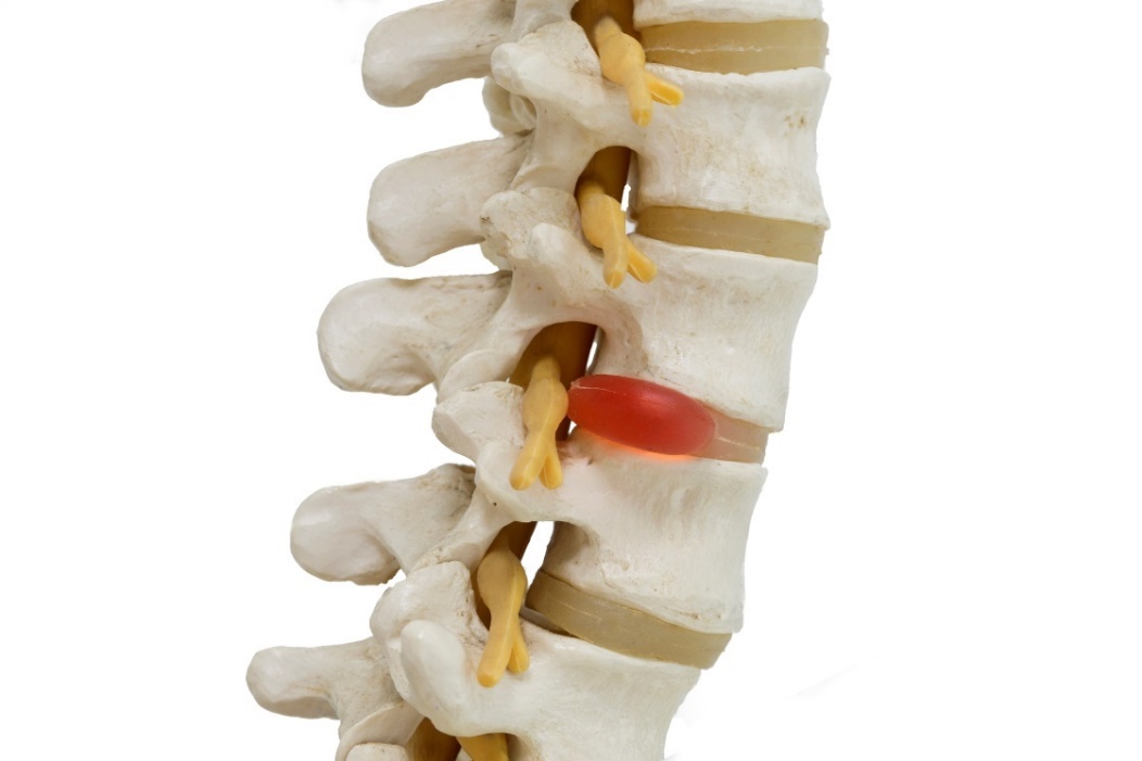 Anatomisk fremstilling av en 3D-modell av ryggraden, mellomvirvelskiver og skiveprolaps med nervekompresjon