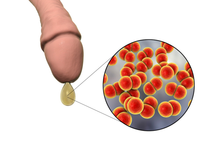 ødem i penis med utflod og mikroskopiske bakterier av gonoré