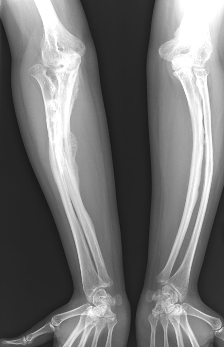 Røntgenbilder av osteogenesis imperfecta hos en voksen