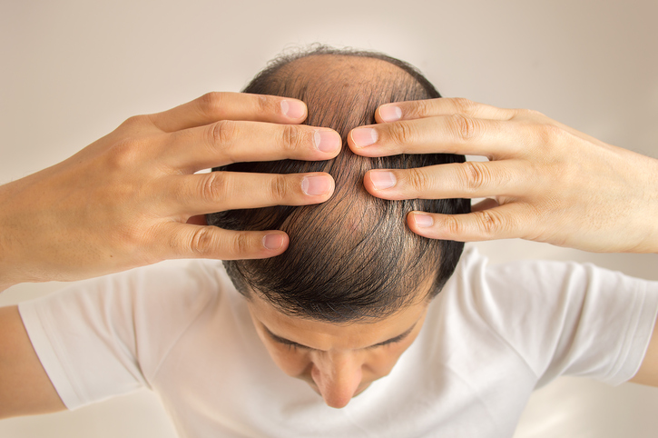 Mann med sparsomt hår, håravfall, skallethet eller alopecia, hendene på hodet, sett ovenfra