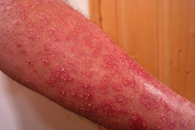 Psoriasis på underarmene, skjellende, rød hud, med tap av hår